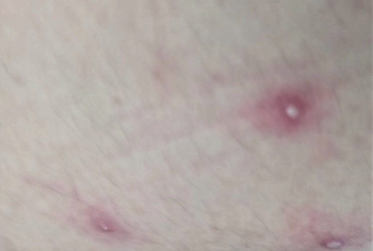 台南衛生局公布國內首位猴痘病例的症狀照片，跟其他國家常見的發痘狀況不盡然相同。（圖 /台南衛生局）